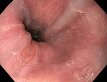esophageal varices grading