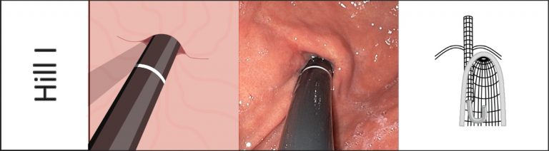 endoscopy-campus-hiatus-hernias-and-the-hill-classification