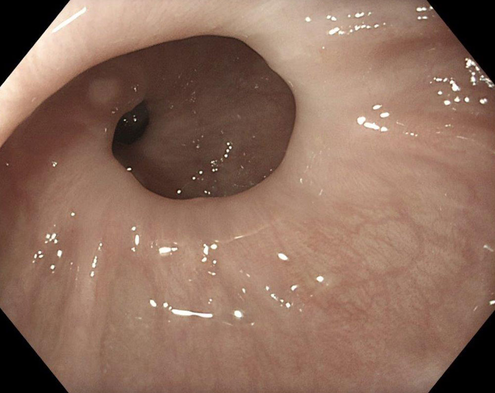 Bild 1: Darstellung des Ösophagus in der Endoskopie