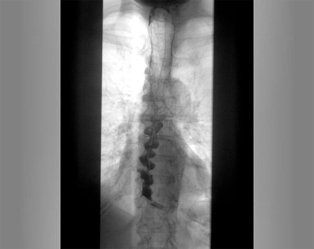 Bild 2: Ösophagus-Breischluck