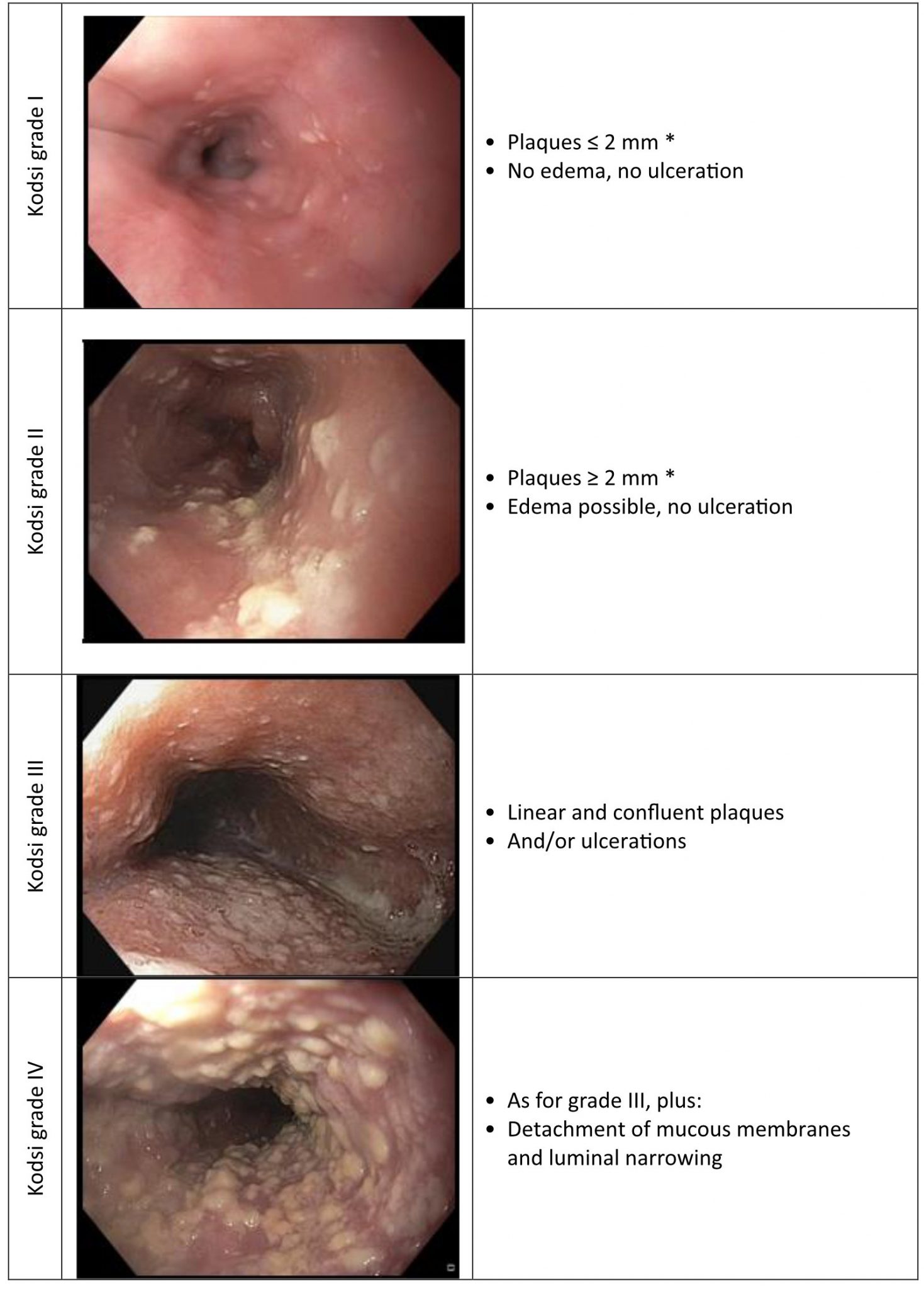 Endoscopy Campus Kodsi Classification Of Candida Esophagitis